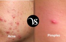 Difference between acne and pimple