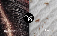 Difference between dandruff and lice