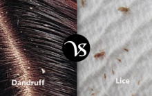 Difference between dandruff and lice