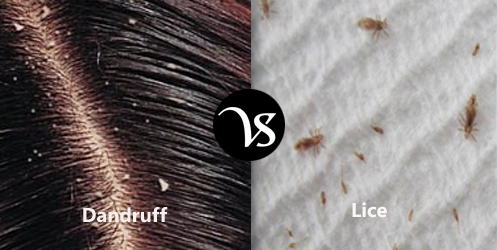 Difference-between-dandruff-and-lice