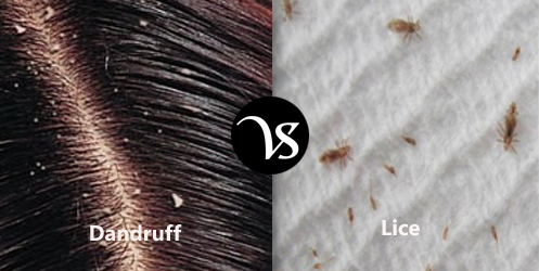 Difference between head lice and dandruff 